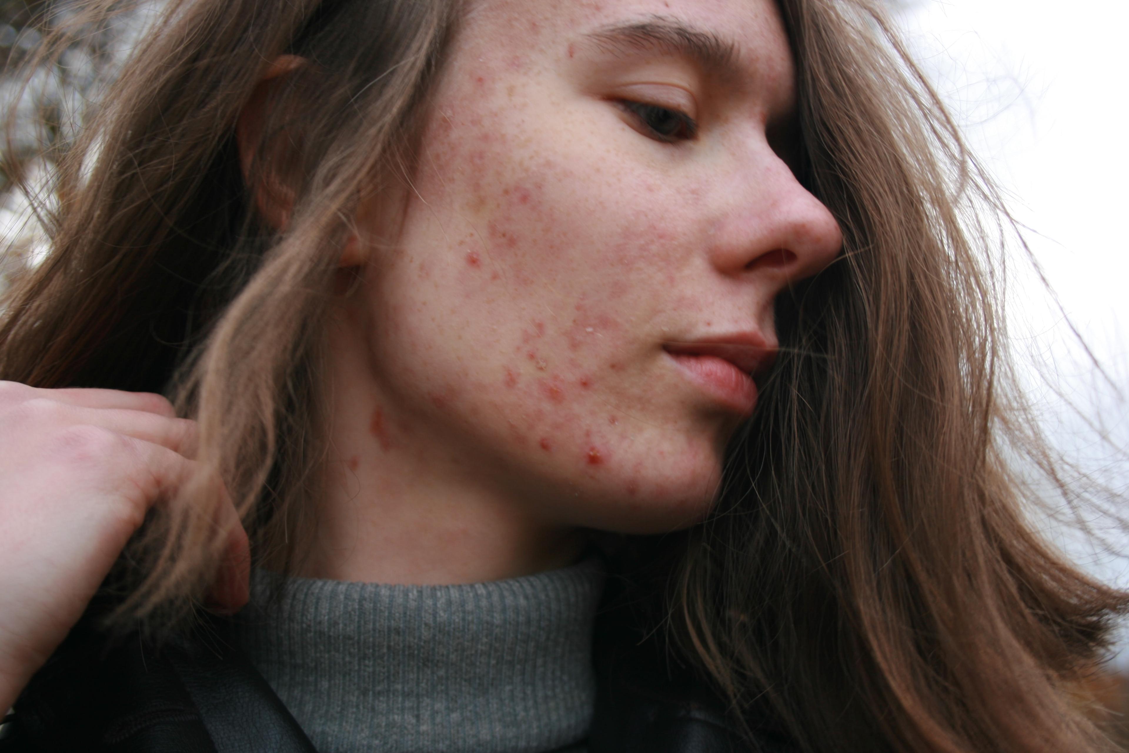 Acne Rosacea Uncovered: Understanding, Causes, and Treatment Strategies. Rosacea Treatment: Review and Update. Exploring the Pathogenesis and Mechanism-Targeted Treatments of Rosacea: Previous Understanding and Updates
