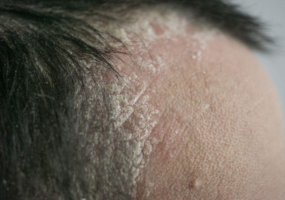 Łojotokowe zapalenie skóry głowy - jak sobie z nim radzić?