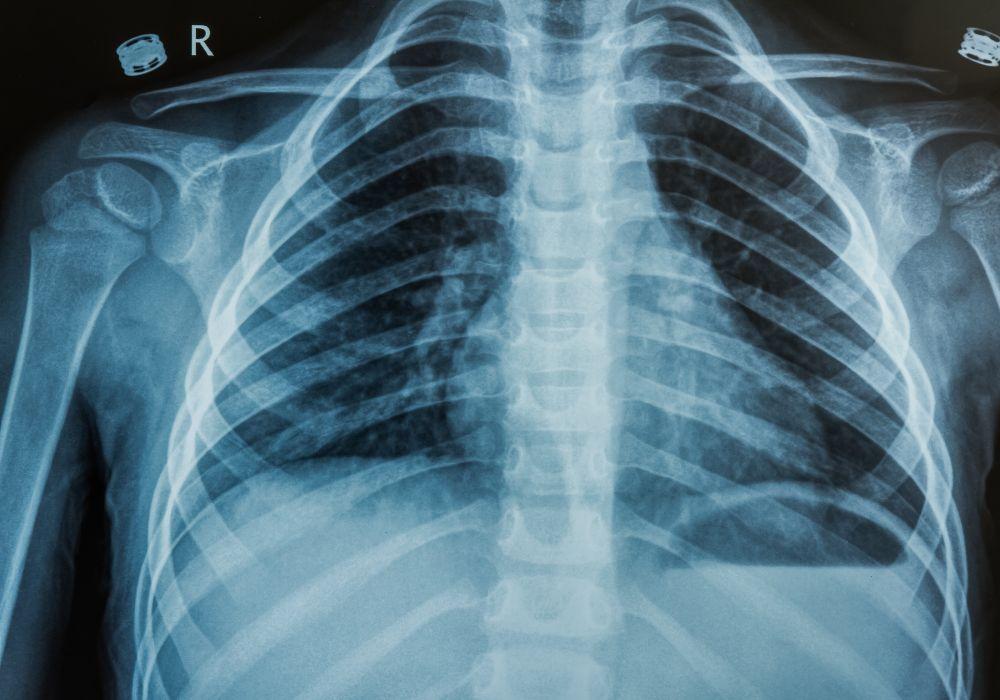 Chest X-rays: Insights into Diagnosis and Interpretation