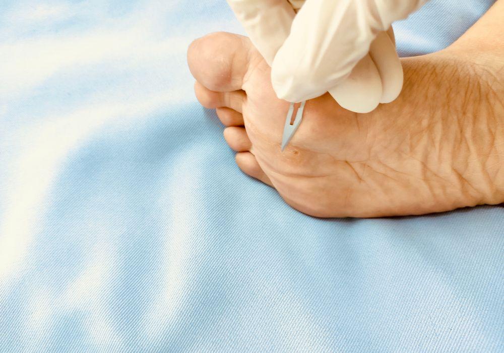 Kurzajki na stopach - przyczyny, objawy i sposoby leczenia